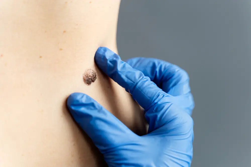 Melanoma